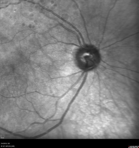 Autoimmune Retinopathy
91 year old female with severe vision loss over the past 3 years.  She has shimmery scotomas.  The main findings are outer retinal atrophy evident on OCT and FAF.  VA 20/80 OD and 20/125 OS
