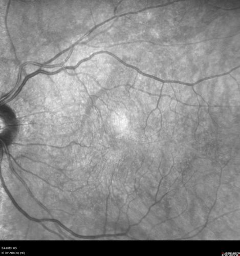 Autoimmune Retinopathy
91 year old female with severe vision loss over the past 3 years.  She has shimmery scotomas.  The main findings are outer retinal atrophy evident on OCT and FAF.  VA 20/80 OD and 20/125 OS
