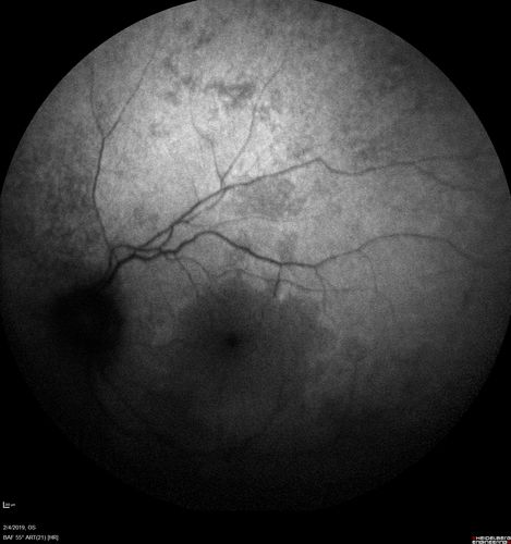Autoimmune Retinopathy
91 year old female with severe vision loss over the past 3 years.  She has shimmery scotomas.  The main findings are outer retinal atrophy evident on OCT and FAF.  VA 20/80 OD and 20/125 OS
