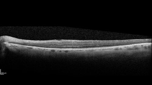 Autoimmune Retinopathy
91 year old female with severe vision loss over the past 3 years.  She has shimmery scotomas.  The main findings are outer retinal atrophy evident on OCT and FAF.  VA 20/80 OD and 20/125 OS
