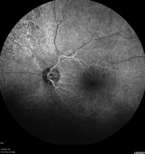 Autoimmune Retinopathy
91 year old female with severe vision loss over the past 3 years.  She has shimmery scotomas.  The main findings are outer retinal atrophy evident on OCT and FAF.  VA 20/80 OD and 20/125 OS
