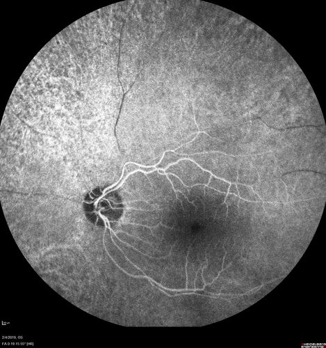 Autoimmune Retinopathy
91 year old female with severe vision loss over the past 3 years.  She has shimmery scotomas.  The main findings are outer retinal atrophy evident on OCT and FAF.  VA 20/80 OD and 20/125 OS

