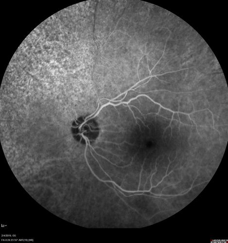 Autoimmune Retinopathy
91 year old female with severe vision loss over the past 3 years.  She has shimmery scotomas.  The main findings are outer retinal atrophy evident on OCT and FAF.  VA 20/80 OD and 20/125 OS

