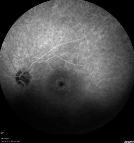 Autoimmune Retinopathy
91 year old female with severe vision loss over the past 3 years.  She has shimmery scotomas.  The main findings are outer retinal atrophy evident on OCT and FAF.  VA 20/80 OD and 20/125 OS
