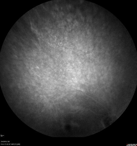 Autoimmune Retinopathy
91 year old female with severe vision loss over the past 3 years.  She has shimmery scotomas.  The main findings are outer retinal atrophy evident on OCT and FAF.  VA 20/80 OD and 20/125 OS
