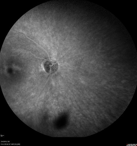 Autoimmune Retinopathy
91 year old female with severe vision loss over the past 3 years.  She has shimmery scotomas.  The main findings are outer retinal atrophy evident on OCT and FAF.  VA 20/80 OD and 20/125 OS
