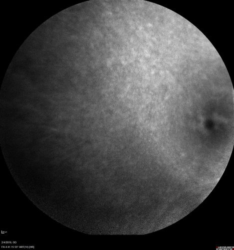 Autoimmune Retinopathy
91 year old female with severe vision loss over the past 3 years.  She has shimmery scotomas.  The main findings are outer retinal atrophy evident on OCT and FAF.  VA 20/80 OD and 20/125 OS
