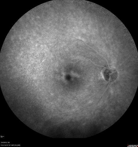 Autoimmune Retinopathy
91 year old female with severe vision loss over the past 3 years.  She has shimmery scotomas.  The main findings are outer retinal atrophy evident on OCT and FAF.  VA 20/80 OD and 20/125 OS
