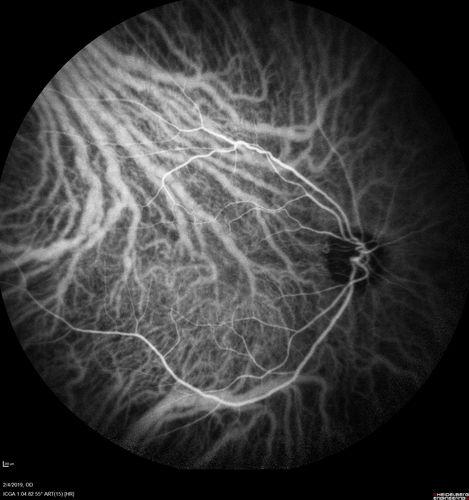 Autoimmune Retinopathy
91 year old female with severe vision loss over the past 3 years.  She has shimmery scotomas.  The main findings are outer retinal atrophy evident on OCT and FAF.  VA 20/80 OD and 20/125 OS
