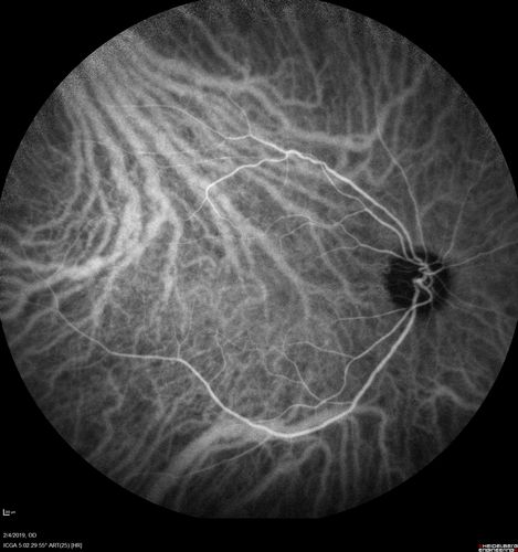 Autoimmune Retinopathy
91 year old female with severe vision loss over the past 3 years.  She has shimmery scotomas.  The main findings are outer retinal atrophy evident on OCT and FAF.  VA 20/80 OD and 20/125 OS
