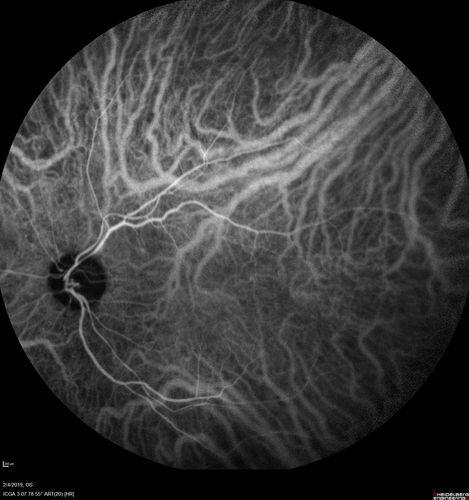 Autoimmune Retinopathy
91 year old female with severe vision loss over the past 3 years.  She has shimmery scotomas.  The main findings are outer retinal atrophy evident on OCT and FAF.  VA 20/80 OD and 20/125 OS
