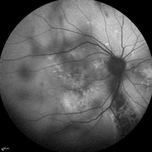 Chronic Central Serous Chorioretinopathy
77 year old man was seen at uveitis clinic and tested positive to  Anti-retinal antibody against 35 kDa and anti-optic nerve antibody.  He did not have EDI OCT, FAF, or ICG.  All testing was consistent with Chronic CSR.  His immunosuppresives were stopped and he did fine for 3 years.
