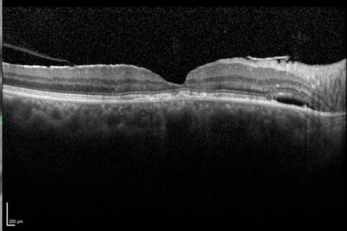Chronic Central Serous Chorioretinopathy
77 year old man was seen at uveitis clinic and tested positive to  Anti-retinal antibody against 35 kDa and anti-optic nerve antibody.  He did not have EDI OCT, FAF, or ICG.  All testing was consistent with Chronic CSR.  His immunosuppresives were stopped and he did fine for 3 years.
