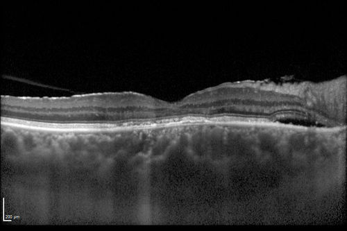 Chronic Central Serous Chorioretinopathy
77 year old man was seen at uveitis clinic and tested positive to  Anti-retinal antibody against 35 kDa and anti-optic nerve antibody.  He did not have EDI OCT, FAF, or ICG.  All testing was consistent with Chronic CSR.  His immunosuppresives were stopped and he did fine for 3 years.
