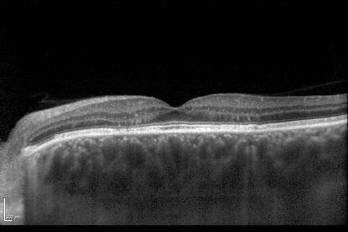 Chronic Central Serous Chorioretinopathy
77 year old man was seen at uveitis clinic and tested positive to  Anti-retinal antibody against 35 kDa and anti-optic nerve antibody.  He did not have EDI OCT, FAF, or ICG.  All testing was consistent with Chronic CSR.  His immunosuppresives were stopped and he did fine for 3 years.
