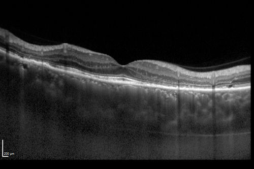 Chronic Central Serous Chorioretinopathy
77 year old man was seen at uveitis clinic and tested positive to  Anti-retinal antibody against 35 kDa and anti-optic nerve antibody.  He did not have EDI OCT, FAF, or ICG.  All testing was consistent with Chronic CSR.  His immunosuppresives were stopped and he did fine for 3 years.

