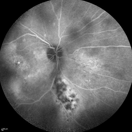 Chronic Central Serous Chorioretinopathy
77 year old man was seen at uveitis clinic and tested positive to  Anti-retinal antibody against 35 kDa and anti-optic nerve antibody.  He did not have EDI OCT, FAF, or ICG.  All testing was consistent with Chronic CSR.  His immunosuppresives were stopped and he did fine for 3 years.
