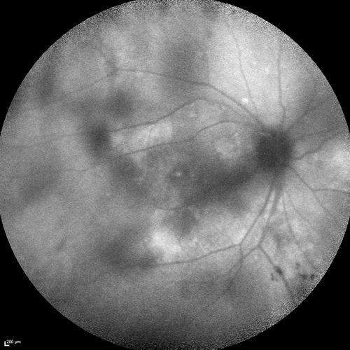 Chronic Central Serous Chorioretinopathy
77 year old man was seen at uveitis clinic and tested positive to  Anti-retinal antibody against 35 kDa and anti-optic nerve antibody.  He did not have EDI OCT, FAF, or ICG.  All testing was consistent with Chronic CSR.  His immunosuppresives were stopped and he did fine for 3 years.
