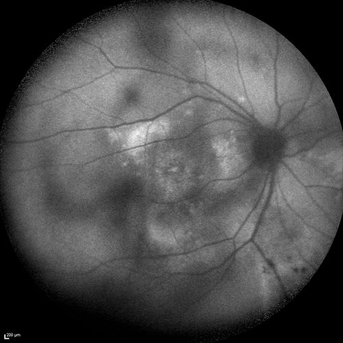 Chronic Central Serous Chorioretinopathy
77 year old man was seen at uveitis clinic and tested positive to  Anti-retinal antibody against 35 kDa and anti-optic nerve antibody.  He did not have EDI OCT, FAF, or ICG.  All testing was consistent with Chronic CSR.  His immunosuppresives were stopped and he did fine for 3 years.
