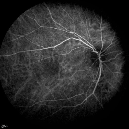 Chronic Central Serous Chorioretinopathy
77 year old man was seen at uveitis clinic and tested positive to  Anti-retinal antibody against 35 kDa and anti-optic nerve antibody.  He did not have EDI OCT, FAF, or ICG.  All testing was consistent with Chronic CSR.  His immunosuppresives were stopped and he did fine for 3 years.
