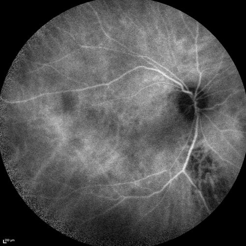 Chronic Central Serous Chorioretinopathy
77 year old man was seen at uveitis clinic and tested positive to  Anti-retinal antibody against 35 kDa and anti-optic nerve antibody.  He did not have EDI OCT, FAF, or ICG.  All testing was consistent with Chronic CSR.  His immunosuppresives were stopped and he did fine for 3 years.

