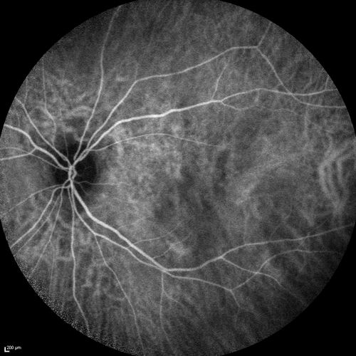 Chronic Central Serous Chorioretinopathy
77 year old man was seen at uveitis clinic and tested positive to  Anti-retinal antibody against 35 kDa and anti-optic nerve antibody.  He did not have EDI OCT, FAF, or ICG.  All testing was consistent with Chronic CSR.  His immunosuppresives were stopped and he did fine for 3 years.
