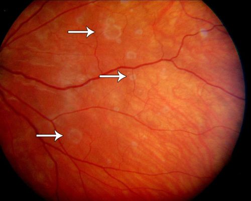 Acute Annular Outer Retinopathy  - VA loss 2 days Right Eye Only - 25 Year Old Woman- AZOOR - White Line Around Fresh Lesions
Initial visit (June 11, 2011): 2 days of vision loss right eye.  Wedge suddenly of VA loss OD, too dardkto see through.  No flashes or floaters.  VA 20/20 OU.


