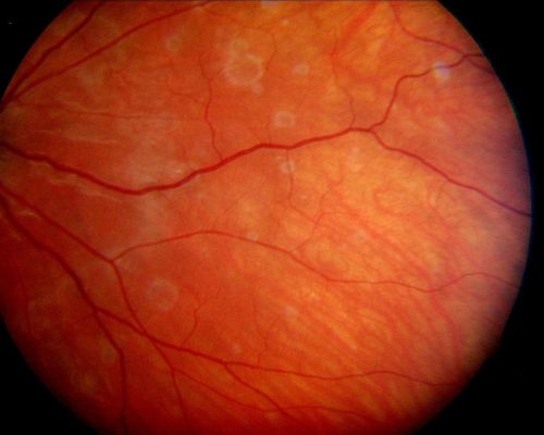 Acute Annular Outer Retinopathy - VA loss 2 days Right Eye Only - 25 Year Old Woman- AZOOR - White Line Around Fresh Lesions
Initial visit (June 11, 2011): 2 days of vision loss right eye.  Wedge suddenly of VA loss OD, too dardkto see through.  No flashes or floaters.  VA 20/20 OU.


