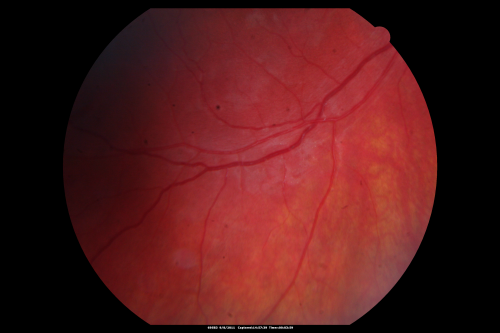 Acute Annular  Outer Retinopathy for 3 Months - 25 YO Female   Fundus Photograph
25-year-old female who, about three months ago, put on her sunglasses and noticed a smudge in the vision and at that point she noticed the right eye was hazy. She had a cold a week or two before the vision loss, but she didnâ€™t have any fever.  She has no focal neurological problems in her past history.  VA 20/20 OU
