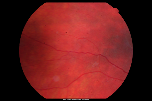 Acute Annular Outer Retinopathy for 3 Months - 25 YO Female   Fundus Photograph
25-year-old female who, about three months ago, put on her sunglasses and noticed a smudge in the vision and at that point she noticed the right eye was hazy. She had a cold a week or two before the vision loss, but she didnâ€™t have any fever.  She has no focal neurological problems in her past history.  VA 20/20 OU
