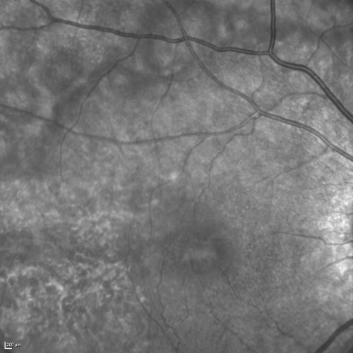 Acute Annular Outer Retinopathy for 3 Months - 25 YO Female   InfraRed Image
25-year-old female who, about three months ago, put on her sunglasses and noticed a smudge in the vision and at that point she noticed the right eye was hazy. She had a cold a week or two before the vision loss, but she didnâ€™t have any fever.  She has no focal neurological problems in her past history.  VA 20/20 OU
