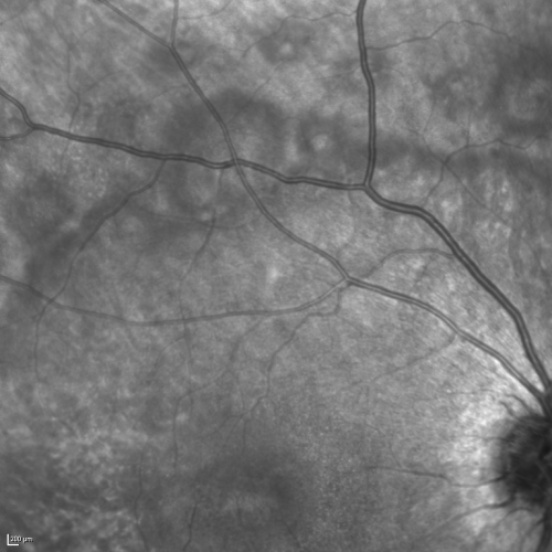 Acute Annular Outer Retinopathy for 3 Months - 25 YO Female   InfraRed Image
25-year-old female who, about three months ago, put on her sunglasses and noticed a smudge in the vision and at that point she noticed the right eye was hazy. She had a cold a week or two before the vision loss, but she didnâ€™t have any fever.  She has no focal neurological problems in her past history.  VA 20/20 OU
