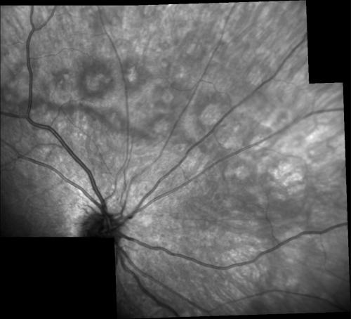 Acute Annular Outer Retinopathy for 3 Months - 25 YO Female   InfraRed Image
25-year-old female who, about three months ago, put on her sunglasses and noticed a smudge in the vision and at that point she noticed the right eye was hazy. She had a cold a week or two before the vision loss, but she didnâ€™t have any fever.  She has no focal neurological problems in her past history.  VA 20/20 OU
