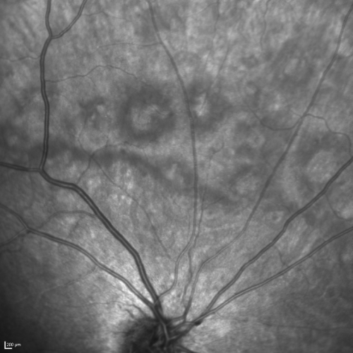 Acute Annular Outer Retinopathy for 3 Months - 25 YO Female   InfraRed Image
25-year-old female who, about three months ago, put on her sunglasses and noticed a smudge in the vision and at that point she noticed the right eye was hazy. She had a cold a week or two before the vision loss, but she didnâ€™t have any fever.  She has no focal neurological problems in her past history.  VA 20/20 OU
