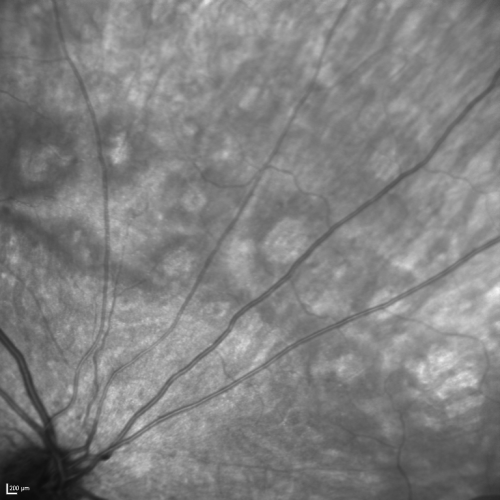 Acute Annular Outer Retinopathy for 3 Months - 25 YO Female   InfraRed Image
25-year-old female who, about three months ago, put on her sunglasses and noticed a smudge in the vision and at that point she noticed the right eye was hazy. She had a cold a week or two before the vision loss, but she didnâ€™t have any fever.  She has no focal neurological problems in her past history.  VA 20/20 OU
