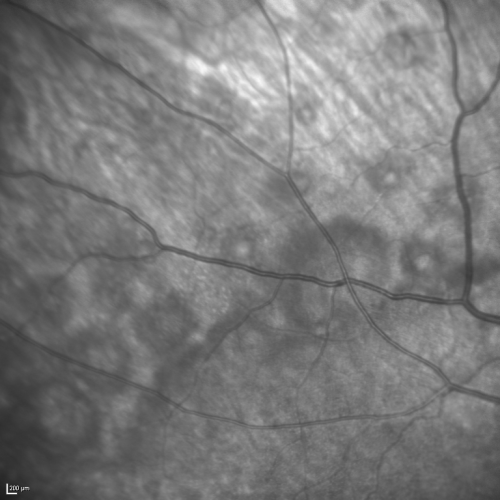 Acute Annular Outer Retinopathy for 3 Months - 25 YO Female   InfraRed Image
25-year-old female who, about three months ago, put on her sunglasses and noticed a smudge in the vision and at that point she noticed the right eye was hazy. She had a cold a week or two before the vision loss, but she didnâ€™t have any fever.  She has no focal neurological problems in her past history.  VA 20/20 OU
