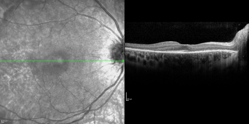 Acute Annular Outer Retinopathy for 3 Months - 25 YO Female   Spectral Domain Optical Coherence Tomgraphy
25-year-old female who, about three months ago, put on her sunglasses and noticed a smudge in the vision and at that point she noticed the right eye was hazy. She had a cold a week or two before the vision loss, but she didnâ€™t have any fever.  She has no focal neurological problems in her past history.  VA 20/20 OU
