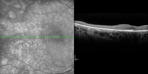 Acute Annular  Outer Retinopathy for 3 Months - 25 YO Female   Spectral Domain Optical Coherence Tomgraphy
25-year-old female who, about three months ago, put on her sunglasses and noticed a smudge in the vision and at that point she noticed the right eye was hazy. She had a cold a week or two before the vision loss, but she didnâ€™t have any fever.  She has no focal neurological problems in her past history.  VA 20/20 OU
