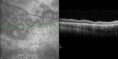 Acute Annular Outer Retinopathy for 3 Months - 25 YO Female   Spectral Domain Optical Coherence Tomgraphy
25-year-old female who, about three months ago, put on her sunglasses and noticed a smudge in the vision and at that point she noticed the right eye was hazy. She had a cold a week or two before the vision loss, but she didnâ€™t have any fever.  She has no focal neurological problems in her past history.  VA 20/20 OU
