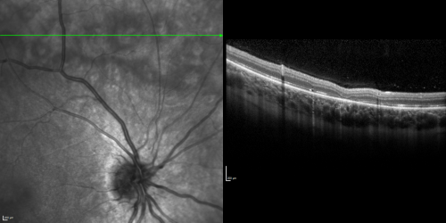 Acute Annular Outer Retinopathy for 3 Months - 25 YO Female   Spectral Domain Optical Coherence Tomgraphy
25-year-old female who, about three months ago, put on her sunglasses and noticed a smudge in the vision and at that point she noticed the right eye was hazy. She had a cold a week or two before the vision loss, but she didnâ€™t have any fever.  She has no focal neurological problems in her past history.  VA 20/20 OU
