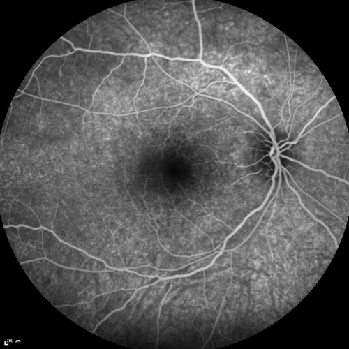 Acute Annular Outer Retinopathy for 3 Months - 25 YO Female   Fluorescein Angiogram
25-year-old female who, about three months ago, put on her sunglasses and noticed a smudge in the vision and at that point she noticed the right eye was hazy. She had a cold a week or two before the vision loss, but she didnâ€™t have any fever.  She has no focal neurological problems in her past history.  VA 20/20 OU
