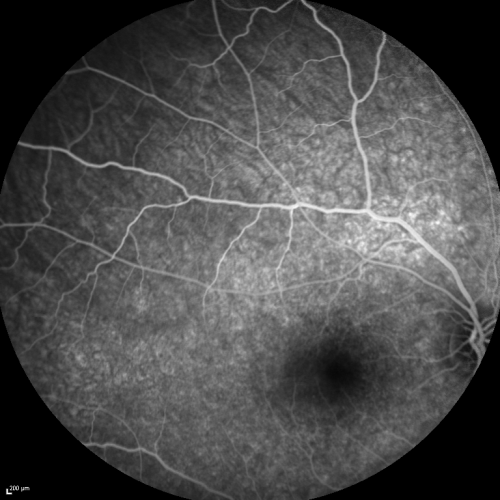 Acute Annular Outer Retinopathy for 3 Months - 25 YO Female  FA
25-year-old female who, about three months ago, put on her sunglasses and noticed a smudge in the vision and at that point she noticed the right eye was hazy. She had a cold a week or two before the vision loss, but she didnâ€™t have any fever.  She has no focal neurological problems in her past history.  VA 20/20 OU
