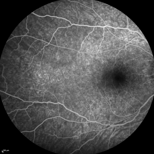 Acute Annular Outer Retinopathy for 3 Months - 25 YO Female  FA
25-year-old female who, about three months ago, put on her sunglasses and noticed a smudge in the vision and at that point she noticed the right eye was hazy. She had a cold a week or two before the vision loss, but she didnâ€™t have any fever.  She has no focal neurological problems in her past history.  VA 20/20 OU

