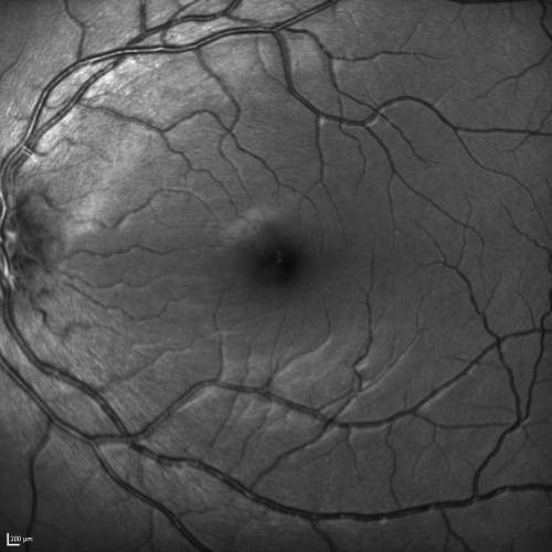 Acute Annular Outer Retinopathy for 3 Months - 25 YO Female   Fellow Normal Eye
25-year-old female who, about three months ago, put on her sunglasses and noticed a smudge in the vision and at that point she noticed the right eye was hazy. She had a cold a week or two before the vision loss, but she didnâ€™t have any fever.  She has no focal neurological problems in her past history.  VA 20/20 OU
