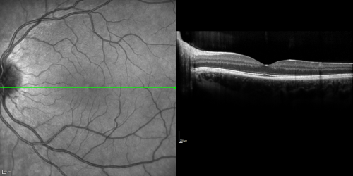 Acute Annular  Outer Retinopathy for 3 Months - 25 YO Female   Fellow Normal Eye
25-year-old female who, about three months ago, put on her sunglasses and noticed a smudge in the vision and at that point she noticed the right eye was hazy. She had a cold a week or two before the vision loss, but she didnâ€™t have any fever.  She has no focal neurological problems in her past history.  VA 20/20 OU
