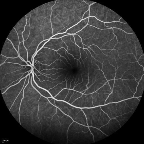Acute Annular Outer Retinopathy for 3 Months - 25 YO Female   Fellow Normal Eye
25-year-old female who, about three months ago, put on her sunglasses and noticed a smudge in the vision and at that point she noticed the right eye was hazy. She had a cold a week or two before the vision loss, but she didnâ€™t have any fever.  She has no focal neurological problems in her past history.  VA 20/20 OU
