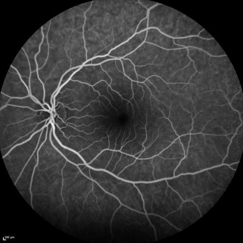 Acute Annular Outer Retinopathy for 3 Months - 25 YO Female   Fellow Normal Eye
25-year-old female who, about three months ago, put on her sunglasses and noticed a smudge in the vision and at that point she noticed the right eye was hazy. She had a cold a week or two before the vision loss, but she didnâ€™t have any fever.  She has no focal neurological problems in her past history.  VA 20/20 OU
