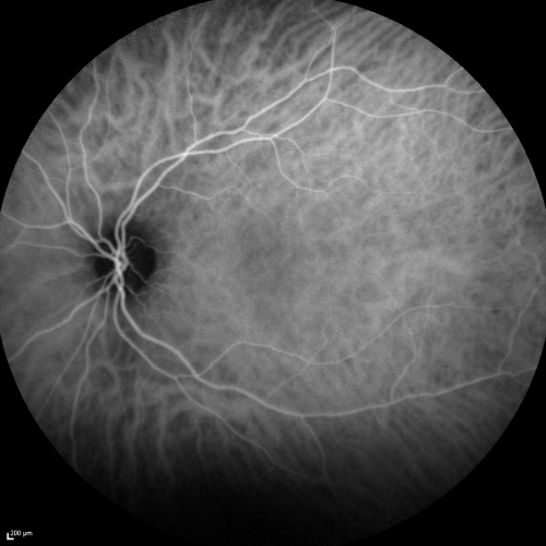 Acute Annular Outer Retinopathy for 3 Months - 25 YO Female  Fellow Normal Eye
25-year-old female who, about three months ago, put on her sunglasses and noticed a smudge in the vision and at that point she noticed the right eye was hazy. She had a cold a week or two before the vision loss, but she didnâ€™t have any fever.  She has no focal neurological problems in her past history.  VA 20/20 OU
