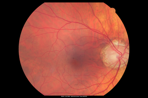 Acute Zonal Occult Outer Retinopathy with Severe Peripheral Vision Loss Left Eye 
 58-year-old man developed a peripheral vision problem about 25 years ago.   OD 20/30, OS 20/40.
Keywords: azoor;bone spicules;retinitis pigmentosa;rp;pseudo