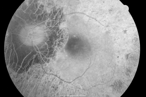 Acute Zonal Occult Outer Retinopathy with Severe Peripheral Vision Loss Left Eye 
 58-year-old man developed a peripheral vision problem about 25 years ago.   OD 20/30, OS 20/40.
Keywords: azoor;bone spicules;retinitis pigmentosa;rp;pseudo